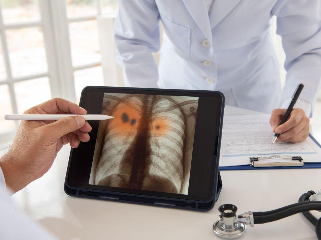 This image shows someone looking at a scan of lungs on a tablet