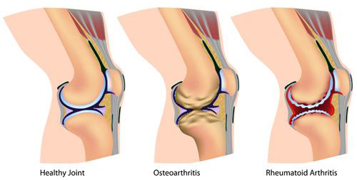 illustratin of arthritic knee