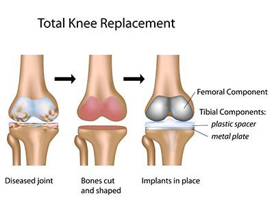 illustration of knee replacement