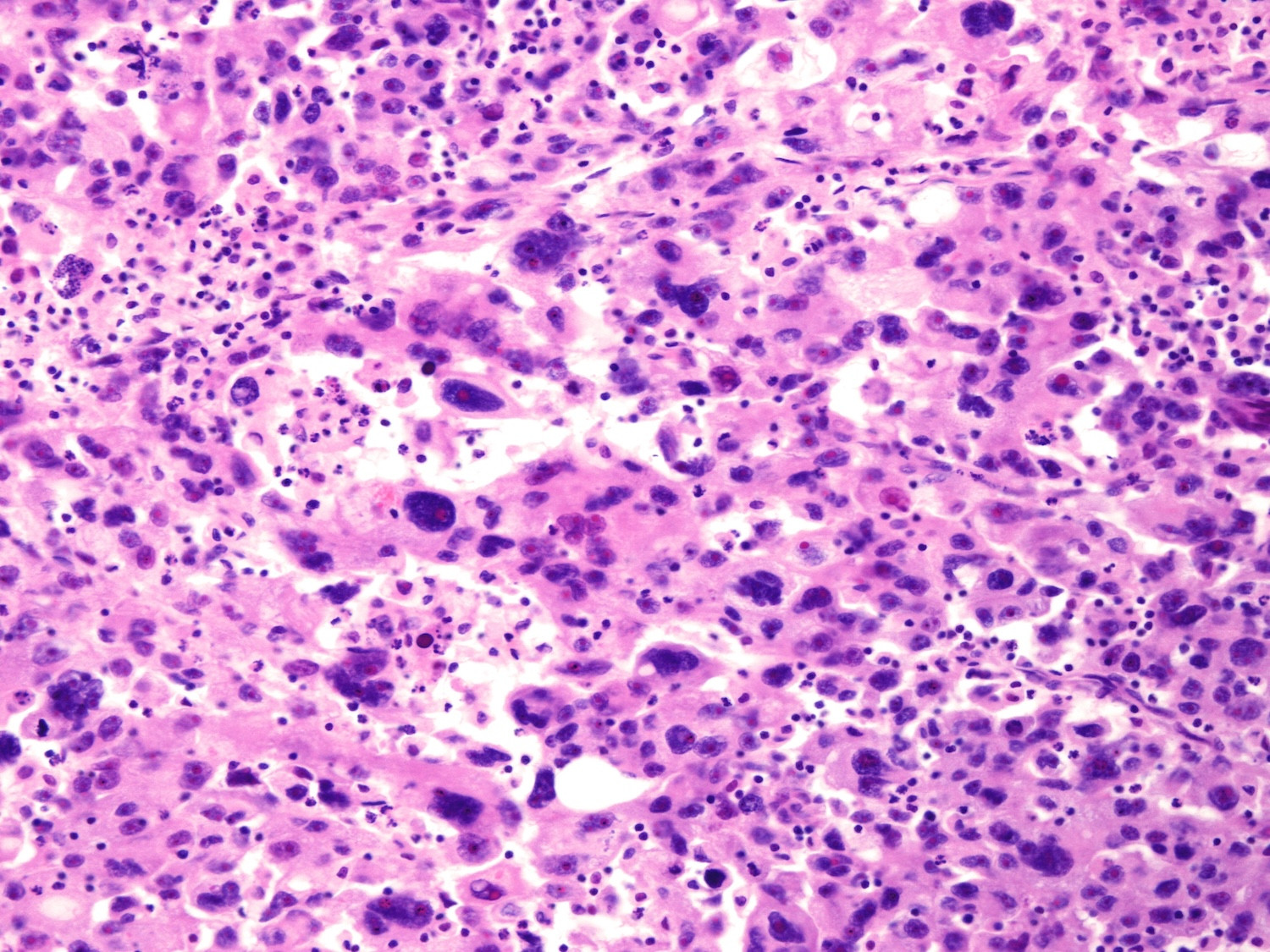 a pink slide under a microscope showing cancer cells