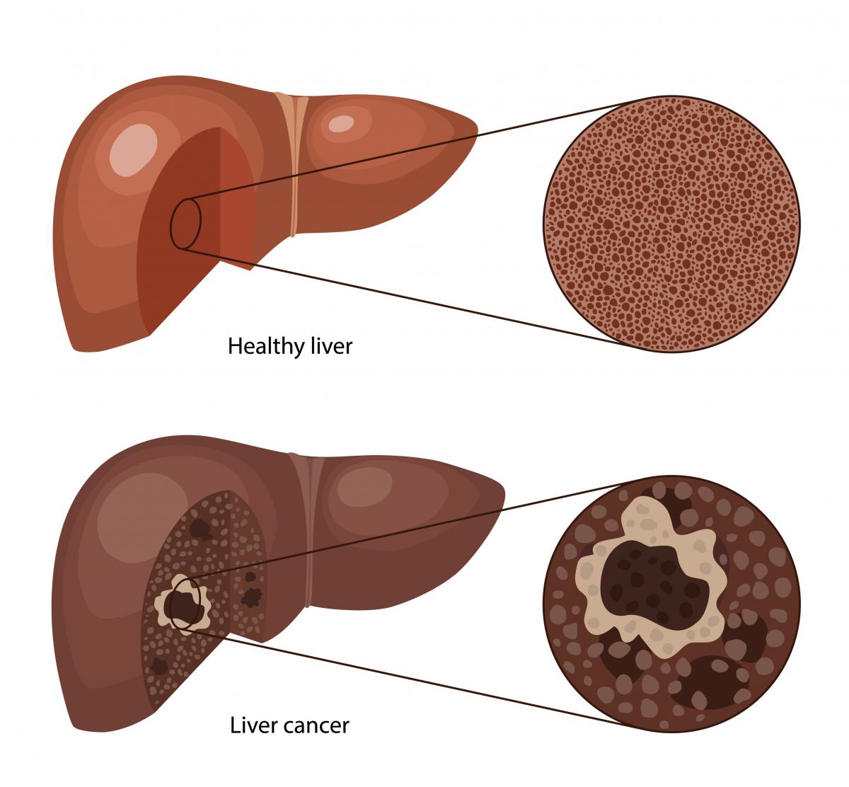 Liver cancer graphic - healthy liver compared to liver cancer