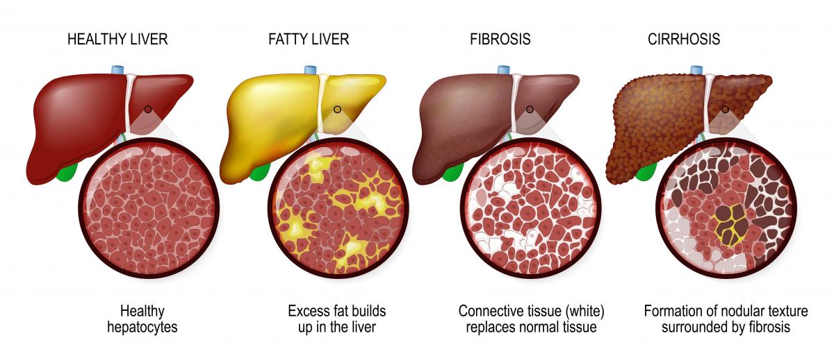 liver diseases stages: healthy, fatty, fibrosis, cirrhosis