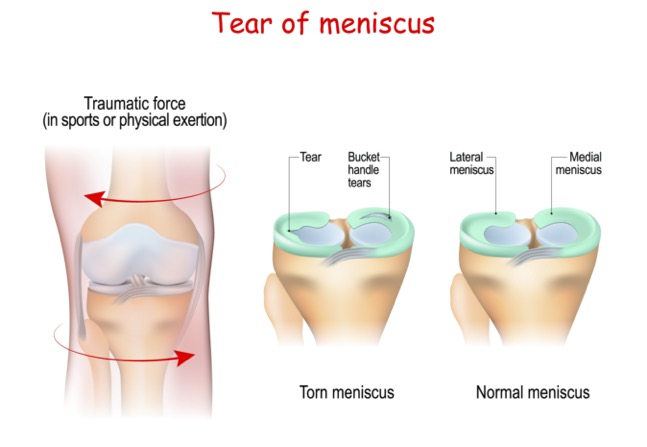 Meniscus tears