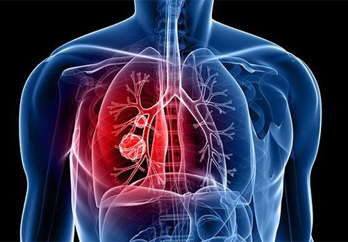 illustration_lung_tumors