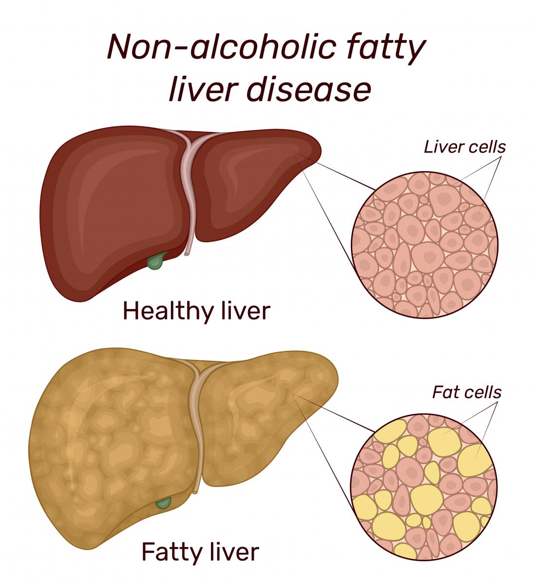 healthy liver compared to fattly liver