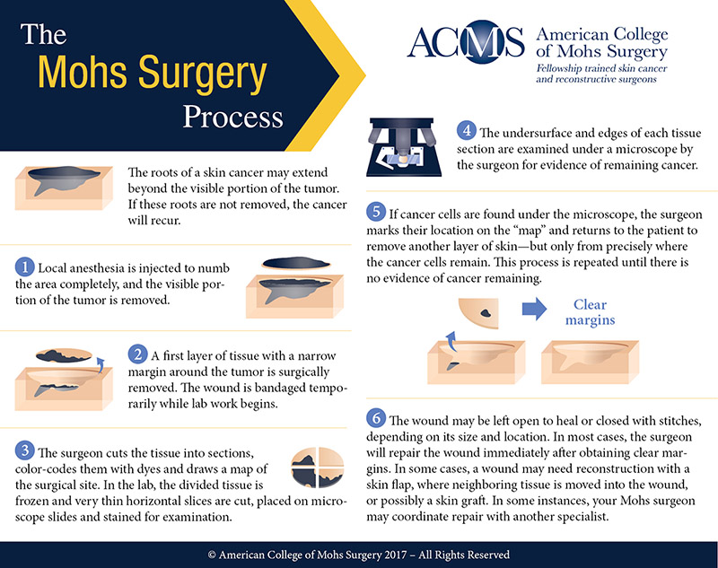 ACMS-Mohs-Surgery-Process-Infographic-
