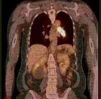PET/CT fusion image of lung cancer