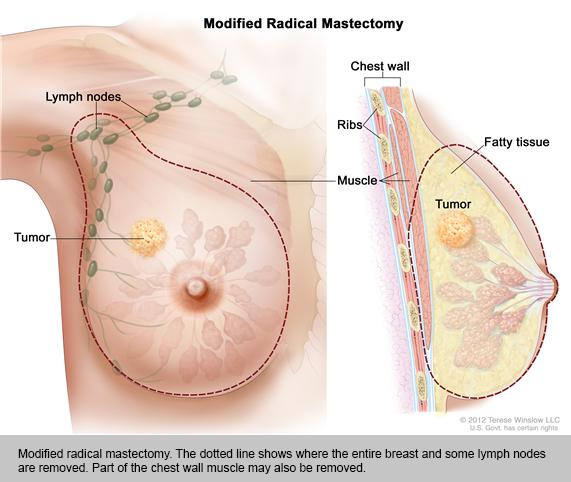Modified-Radical-Mastectomy