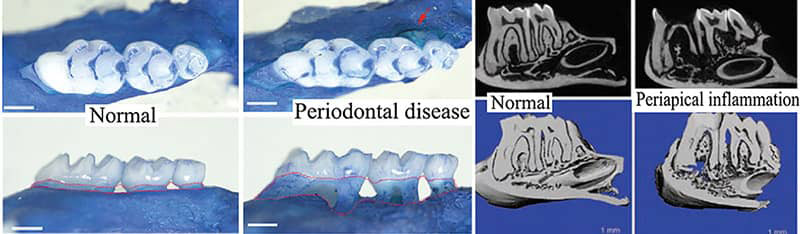 peridontal disease