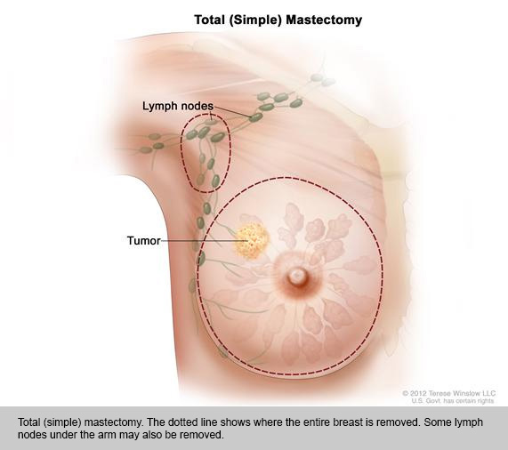 Total Simple Mastectomy