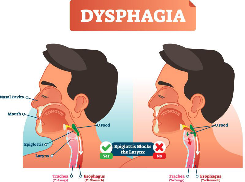 dysphagia illustration
