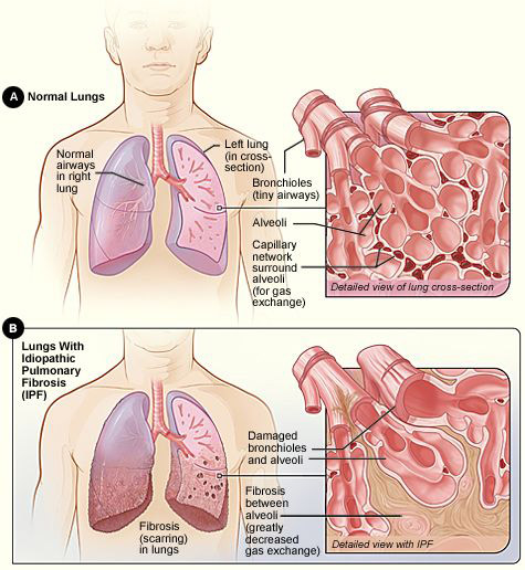 lung fibrosis illustration