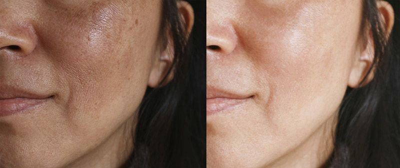 woman's face with melasma