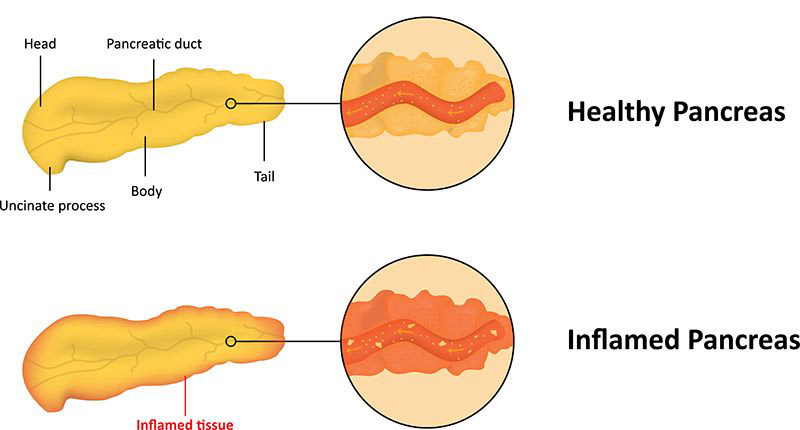 healthy & inflamed pancreas illustration