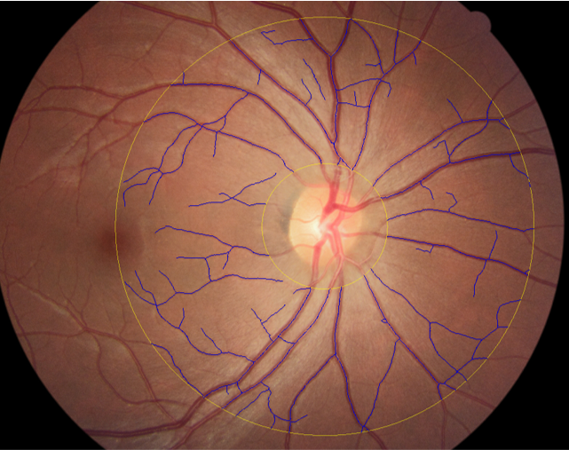 retinal image analysis program