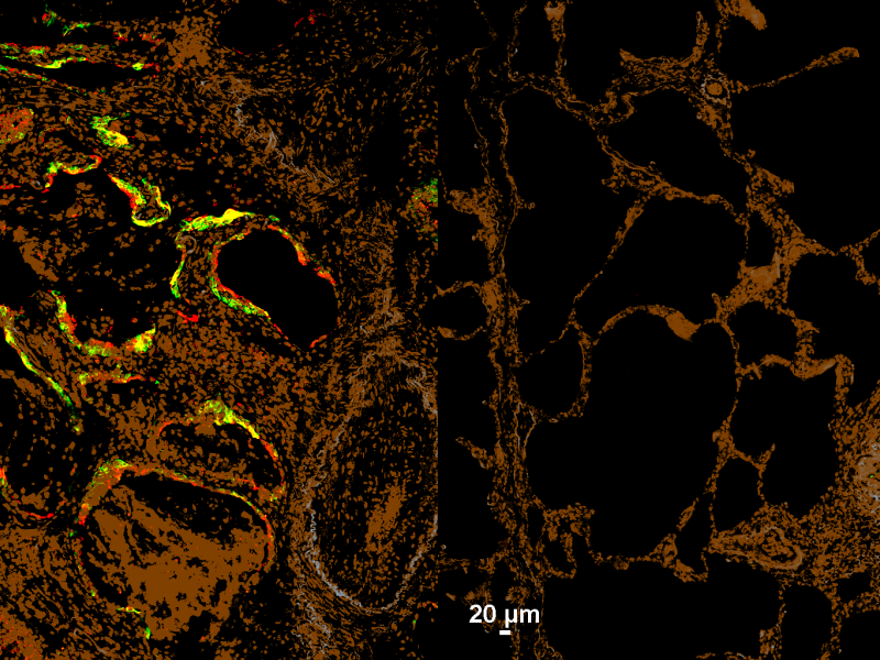 Injury-stalled alveolar stem cells