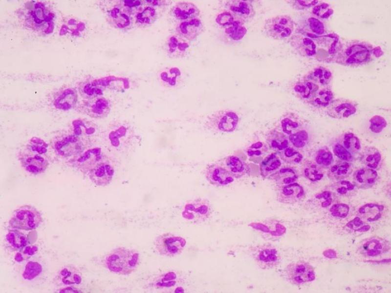 a photo of pink looking cells identified as sepsis