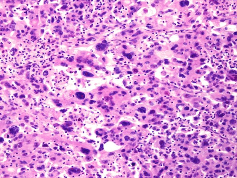 a pink slide under a microscope showing cancer cells