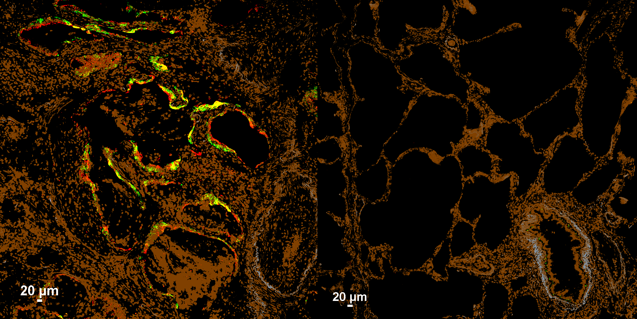 Injury-stalled alveolar stem cells