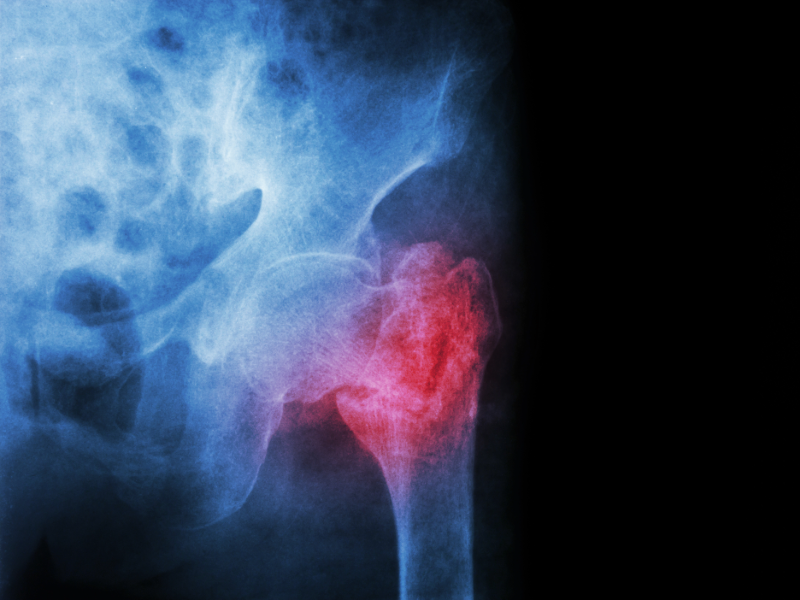 An xray showing a pelvis with the hip bone highlighted in red